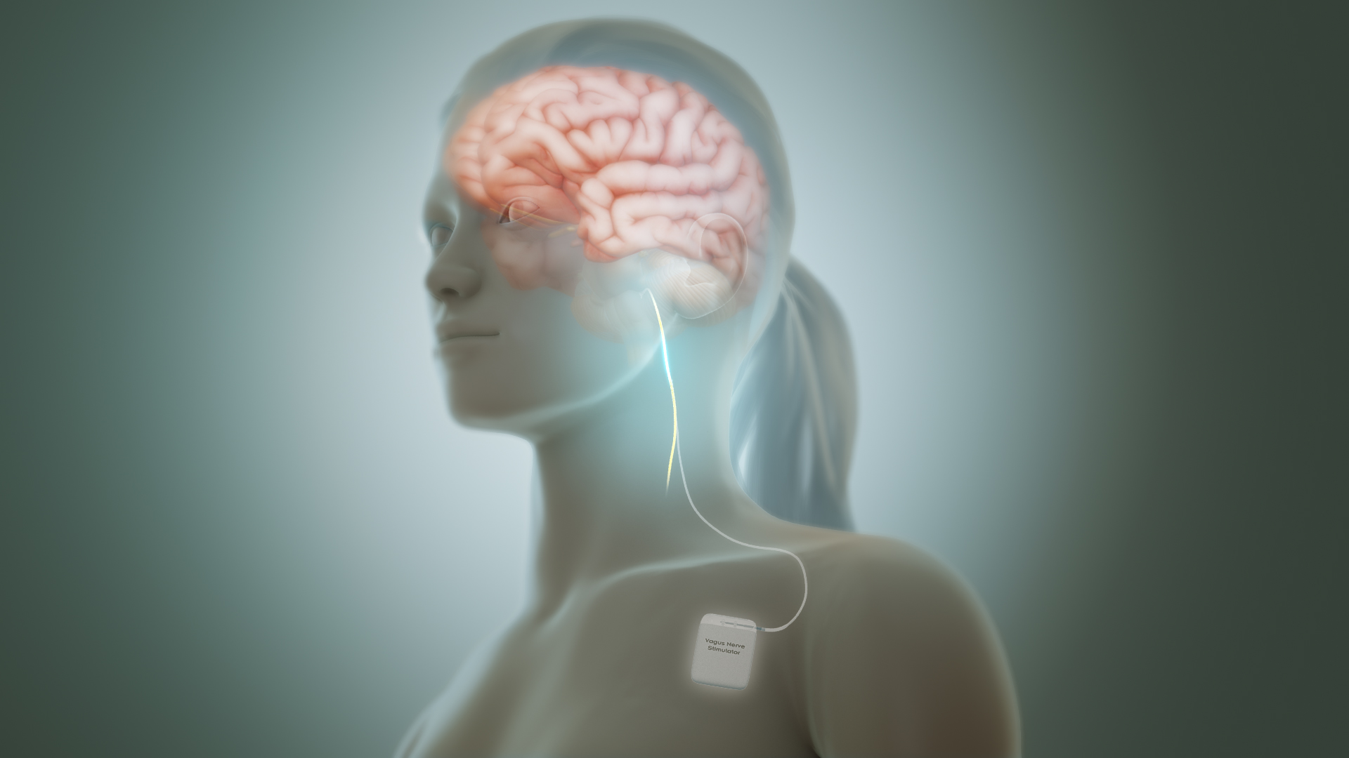 Vagus_nerve_stimulation